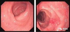 萎縮性胃炎不可怕，只要
